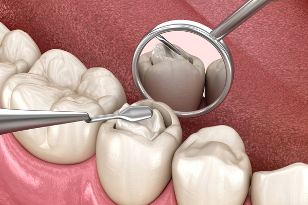 How Do Tooth Colored Fillings Work?