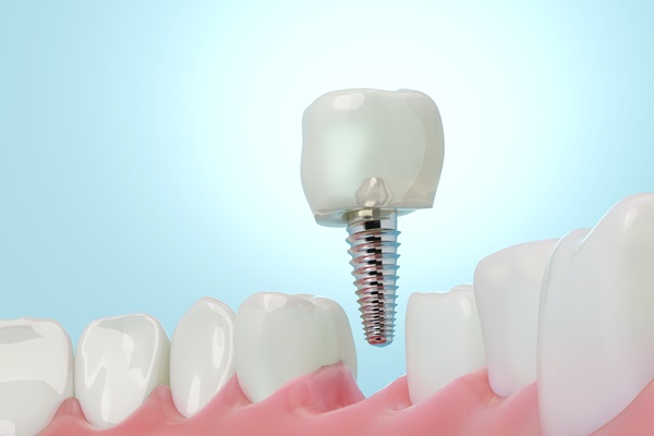 Why You Should Consider Tooth Replacement